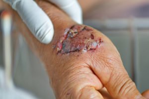 Dog bite hand wound was infection