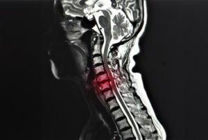 What Is the Average Settlement for Cervical Radiculopathy After a Car Accident?