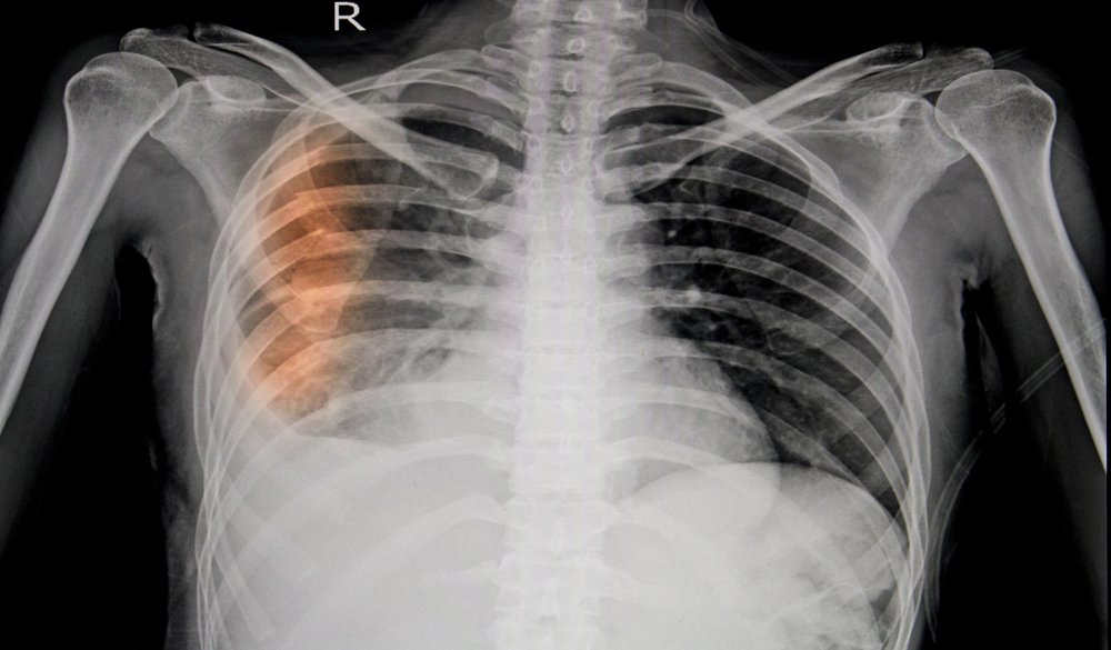 broken rib punctured lung