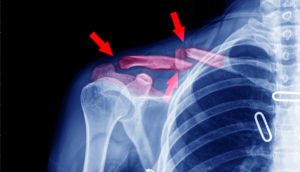 What Is the Average Settlement for a Broken Collarbone?