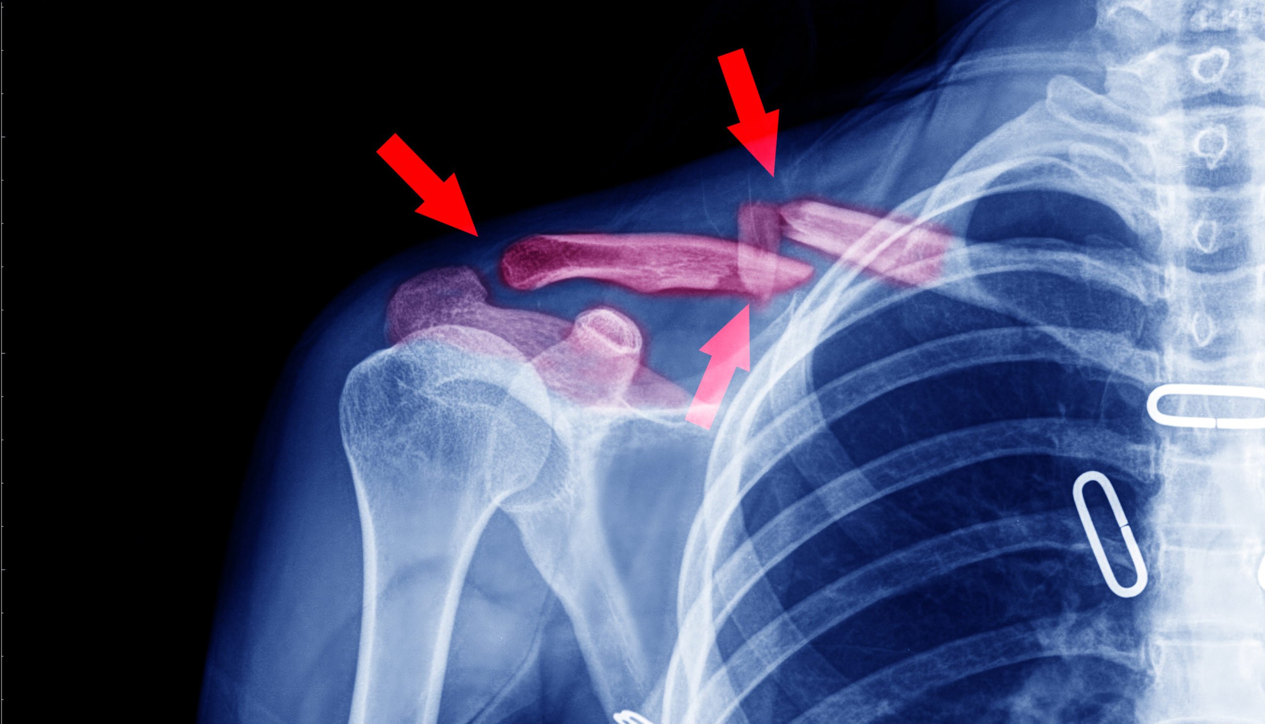 What Is the Average Settlement for a Broken Collarbone? Laborde