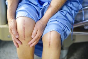 How Do I Know if My Knee Replacement Has Been Recalled?
