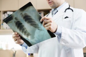 What Is the Average Settlement for Broken Ribs from a Car Accident?
